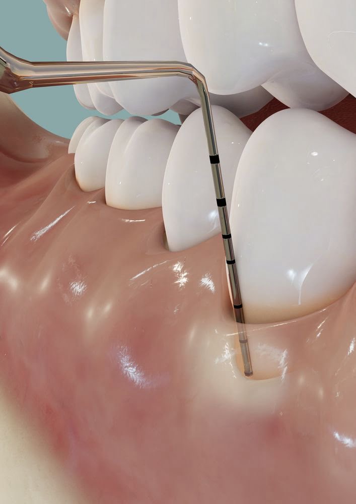cirugía periodontal