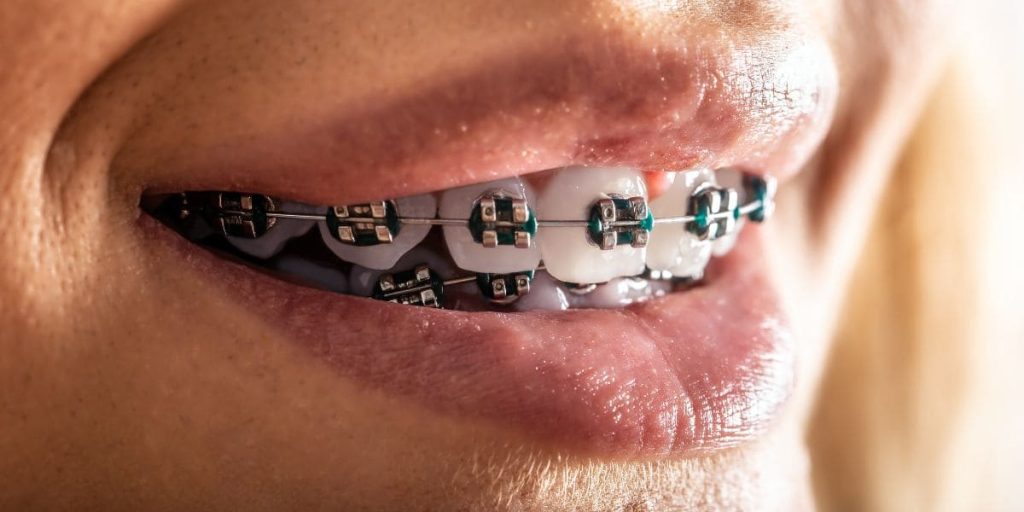 brackets linguales