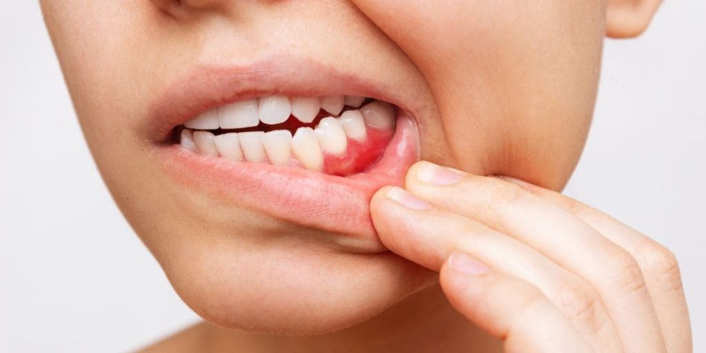 Encía inflamada y enrojecida junto a los dientes, uno de los primeros signos de la periodontitis