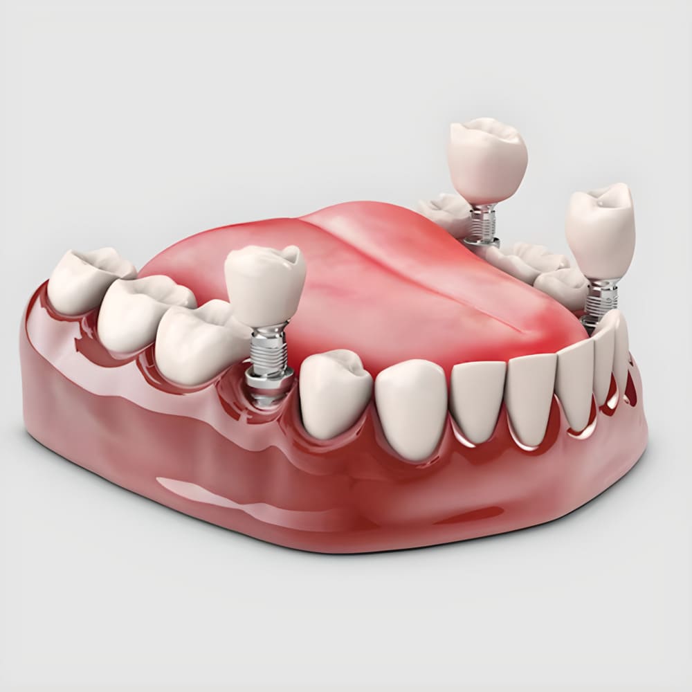 implante dental zaragoza