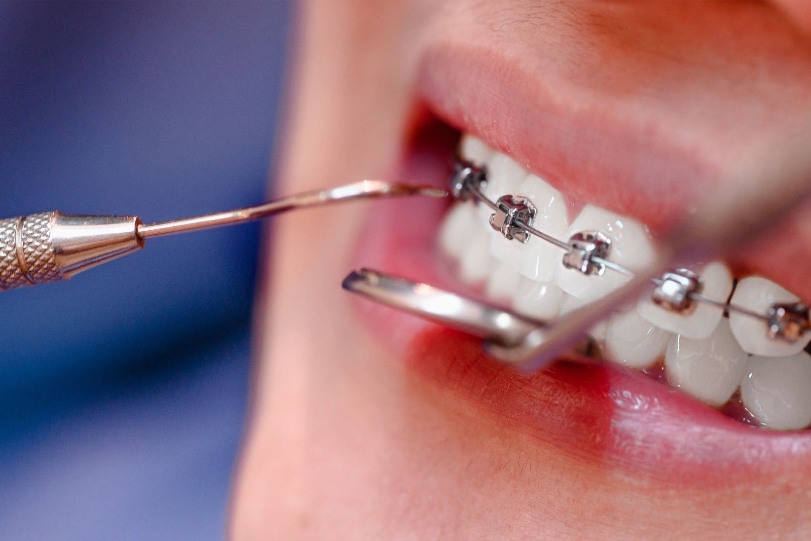 Boca con brackets metálicos mientras el odontólogo ajusta el arco con una sonda y un separador