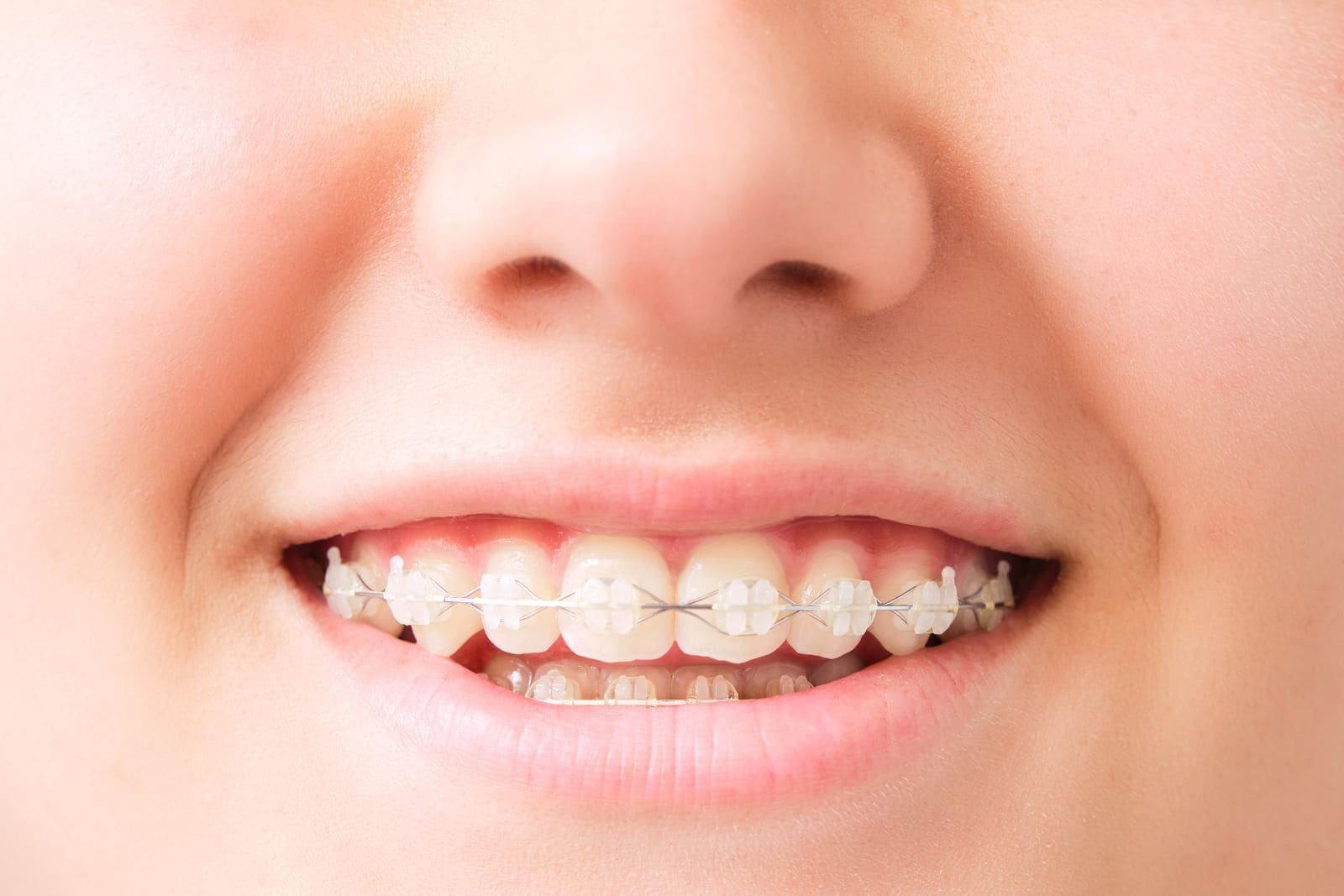 Sonrisa con brackets de cerámica del color del diente y su arco en la arcada superior
