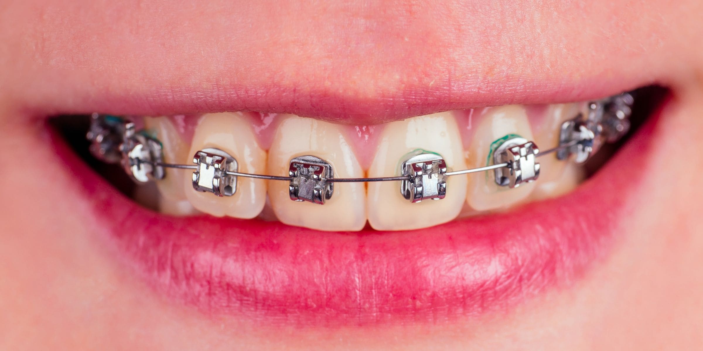 Sonrisa con brackets metálicos y ligaduras de colores en la arcada superior
