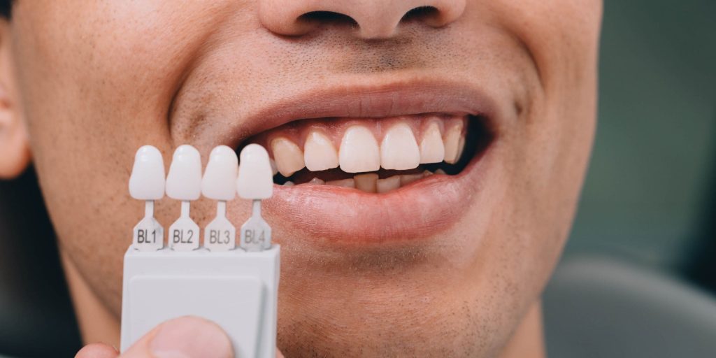 Guía de colores dentales BL1 a BL4 comparada junto a los dientes del paciente