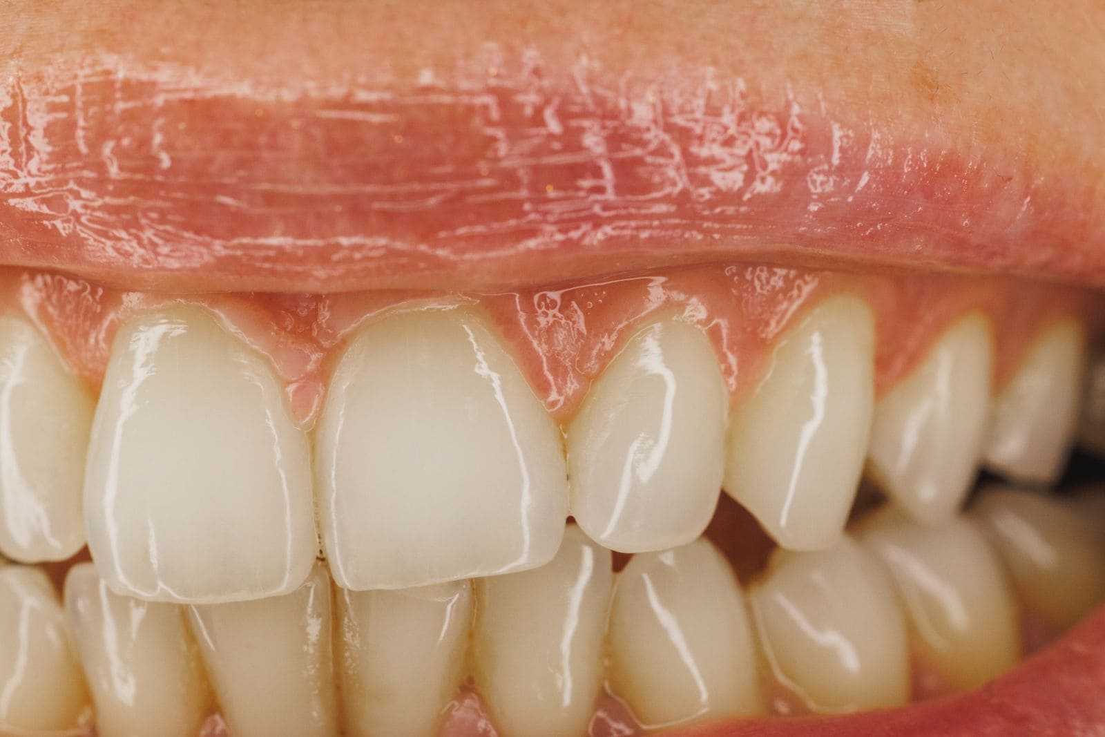 Primer plano de la encía y de los dientes superiores e inferiores en oclusión