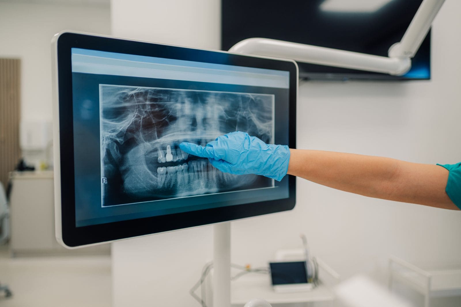 Mano enguantada señalando dos implantes en una radiografía panorámica mostrada en la pantalla del gabinete