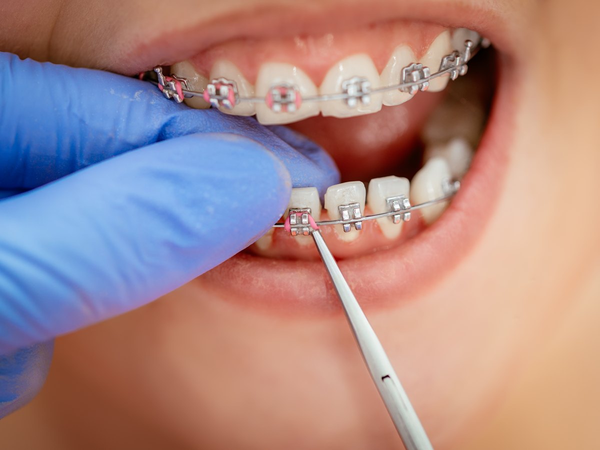 Brackets metálicos con gomas rosas mientras la dentista ajusta el arco