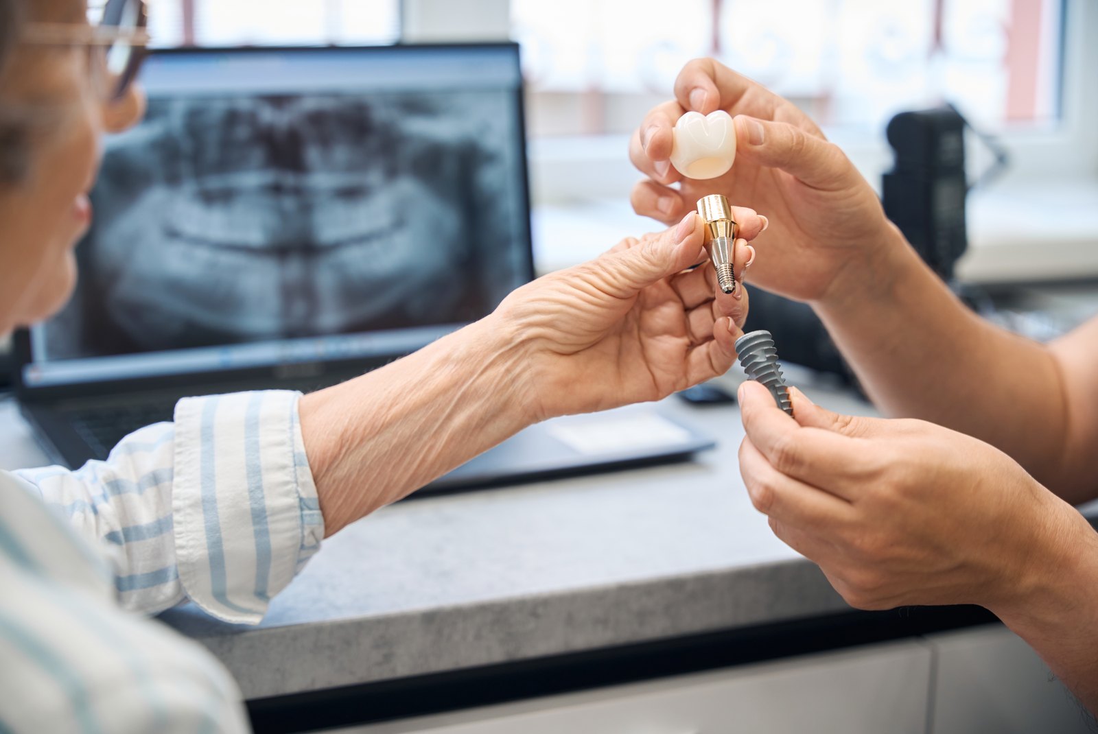 Modelo de implante dental con su corona junto a una radiografía en la consulta