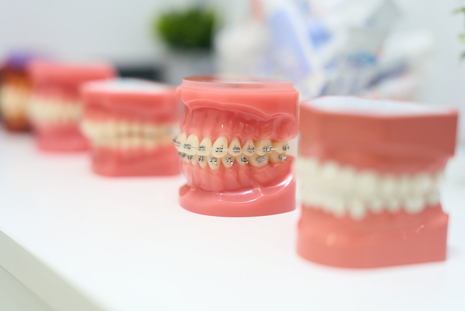 Modelos dentales, uno de ellos con brackets metálicos