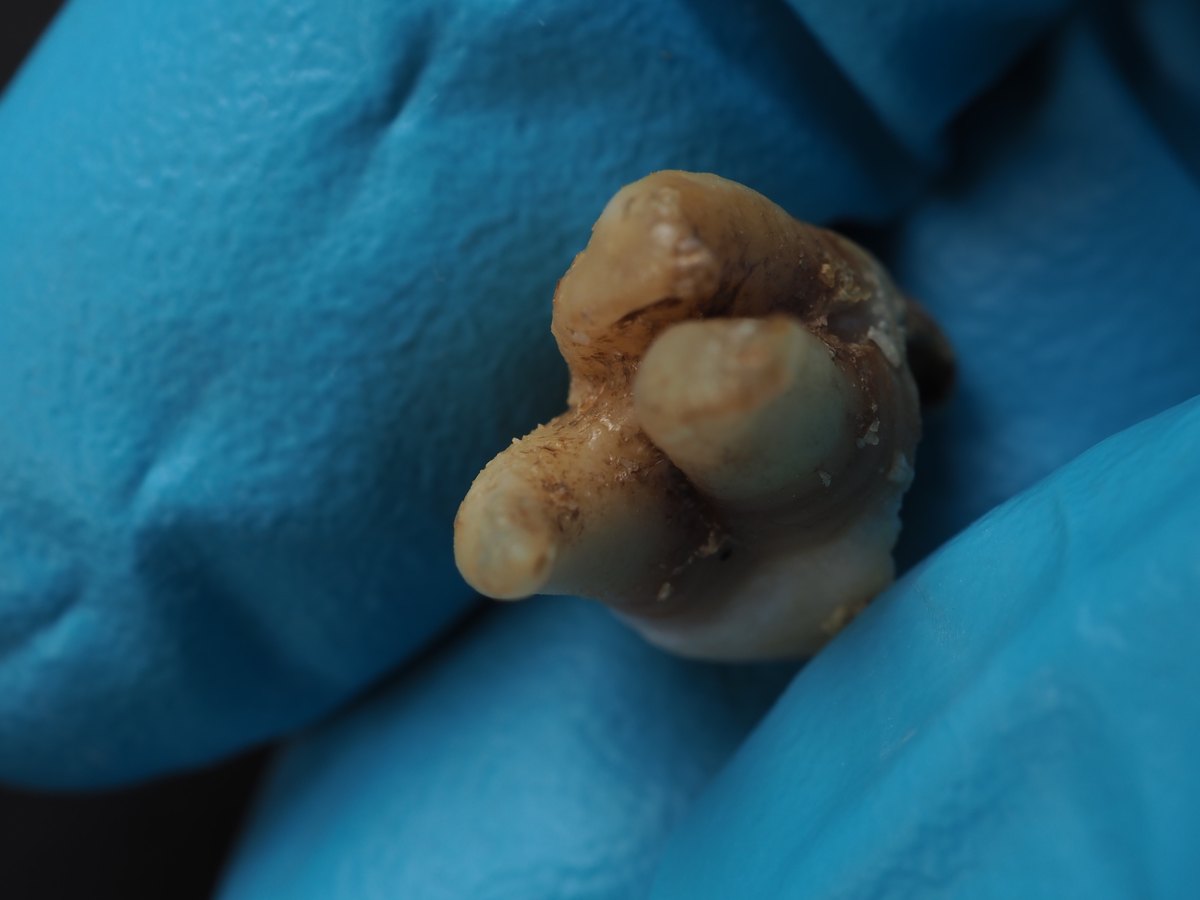 Extracted molar held by the dentist in gloves