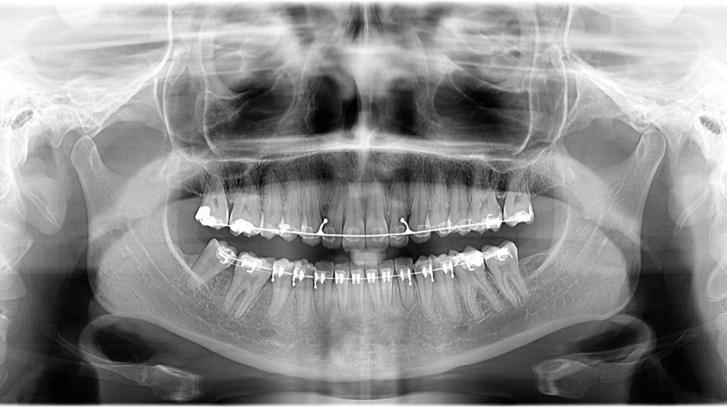 Radiografía panorámica dental en la que se ven las muelas del juicio