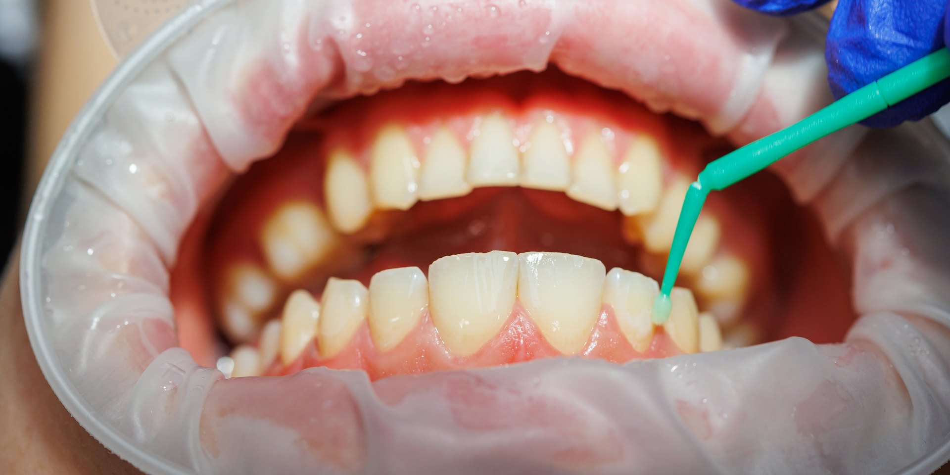 Dentista aplicando un producto con un microcepillo en el cuello de un diente inferior, junto a la encía