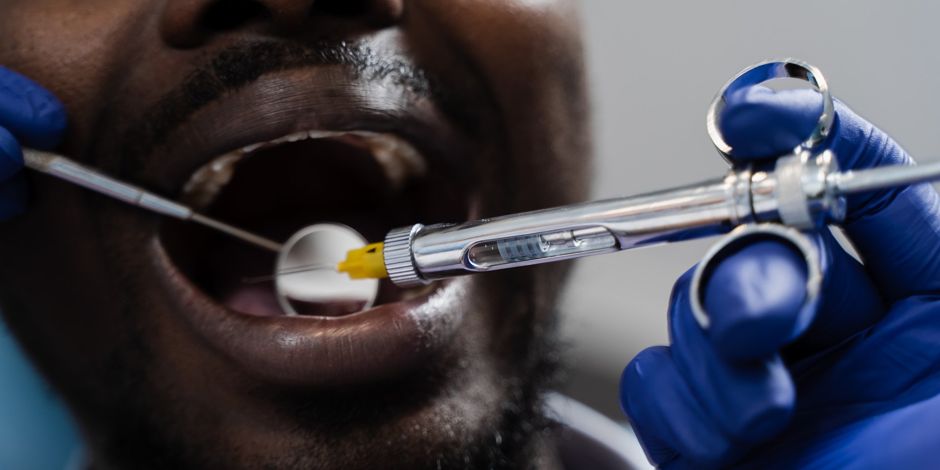 Dentista con guantes azules acercando la jeringa de anestesia local a la boca abierta del paciente