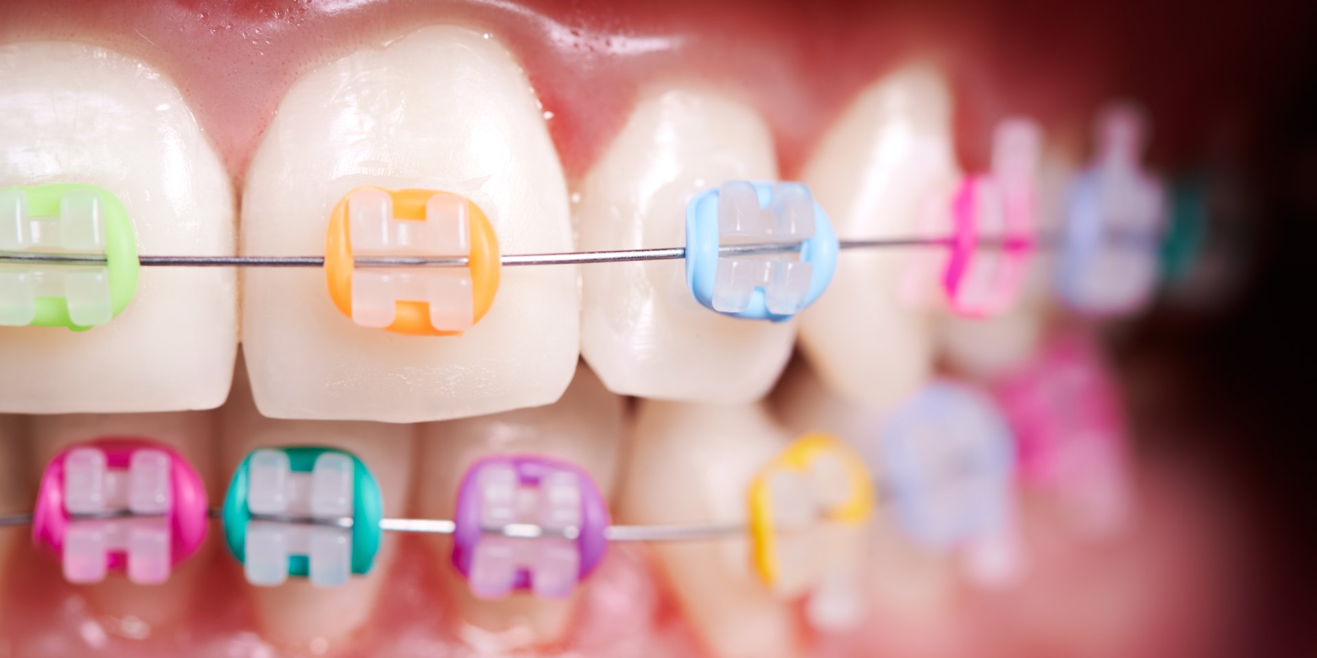 Brackets translúcidos con ligaduras elásticas de colores sobre los dientes