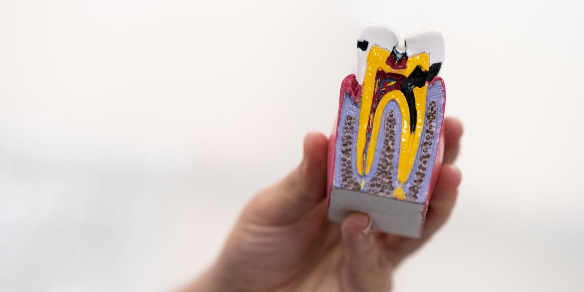 Mano sosteniendo la maqueta de una muela cortada por la mitad con una caries que llega hasta el nervio
