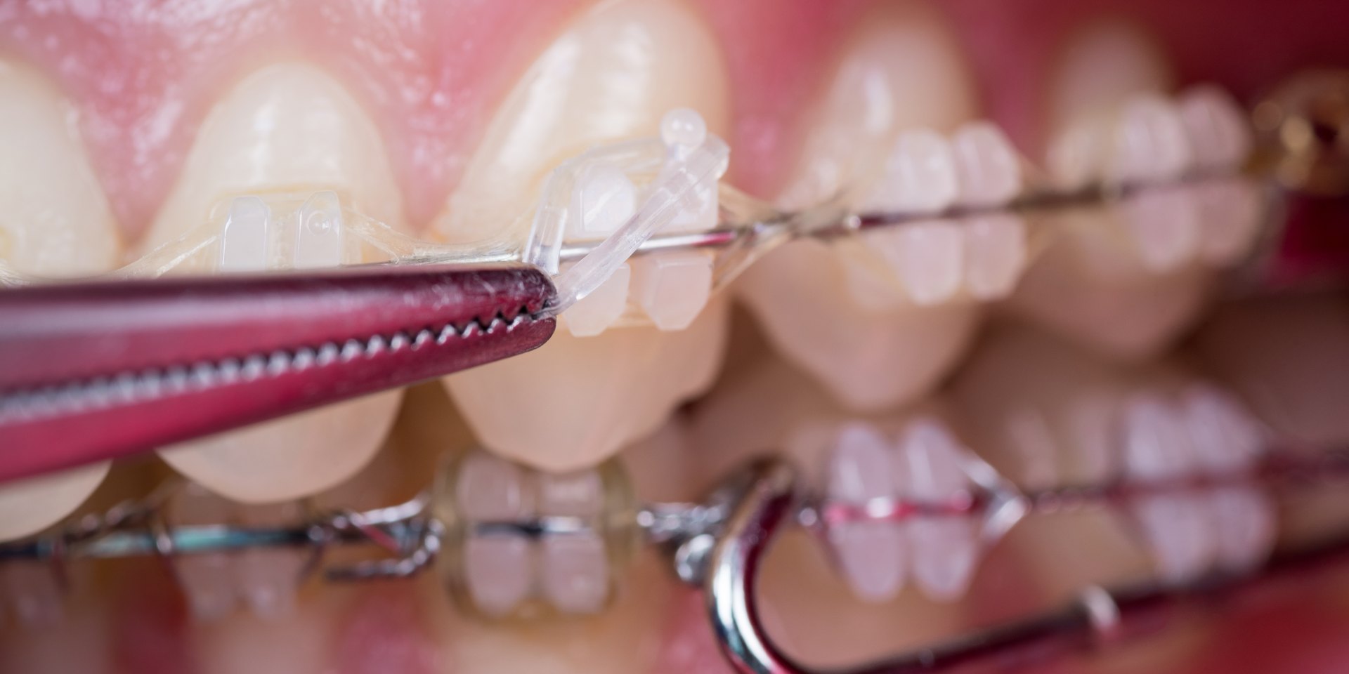 Primer plano de brackets cerámicos del color del diente unidos por el arco de ortodoncia