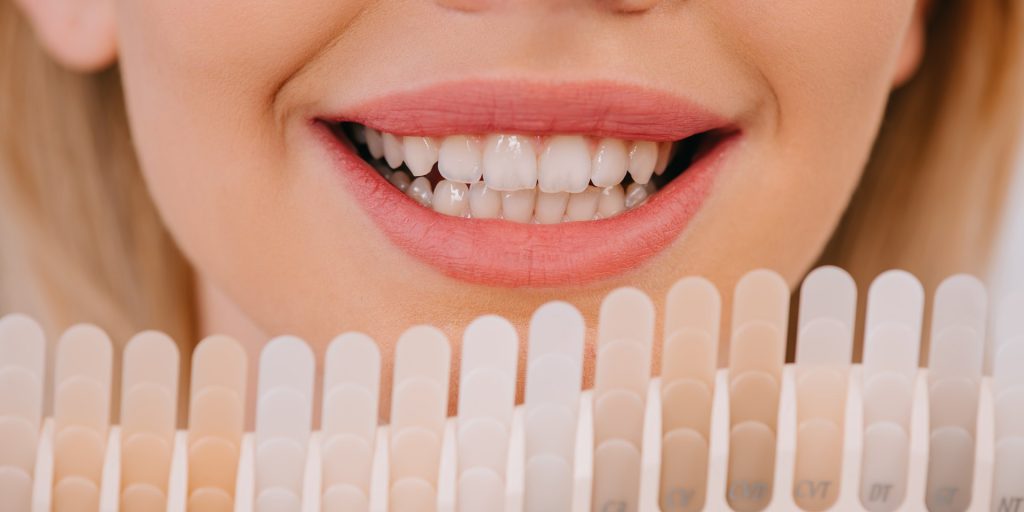 Sonrisa de una mujer junto a una guía de colores dentales para comparar el tono del esmalte