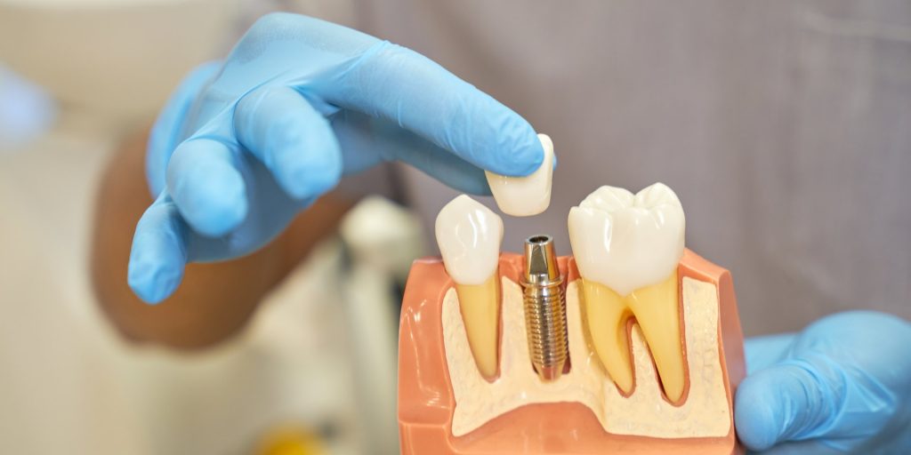 Manos con guantes azules colocando una corona sobre un implante dental en un modelo de encía