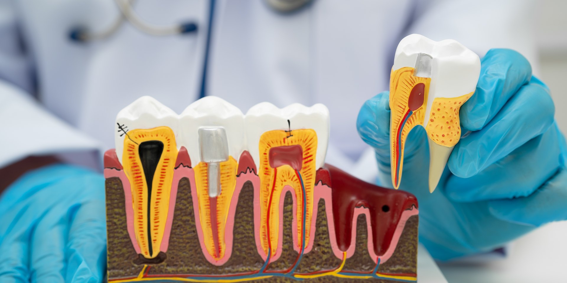 Modelo de dientes en corte: uno con la pulpa necrosada en negro y otro con un perno