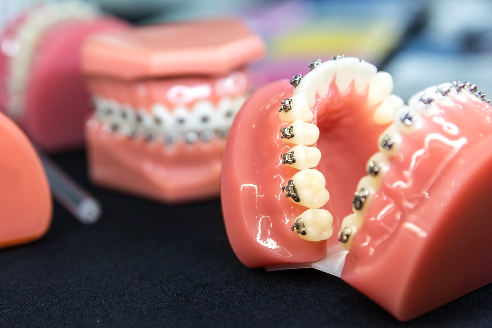 Modelos de arcadas dentales con brackets; en primer plano, la arcada superior vista desde el paladar
