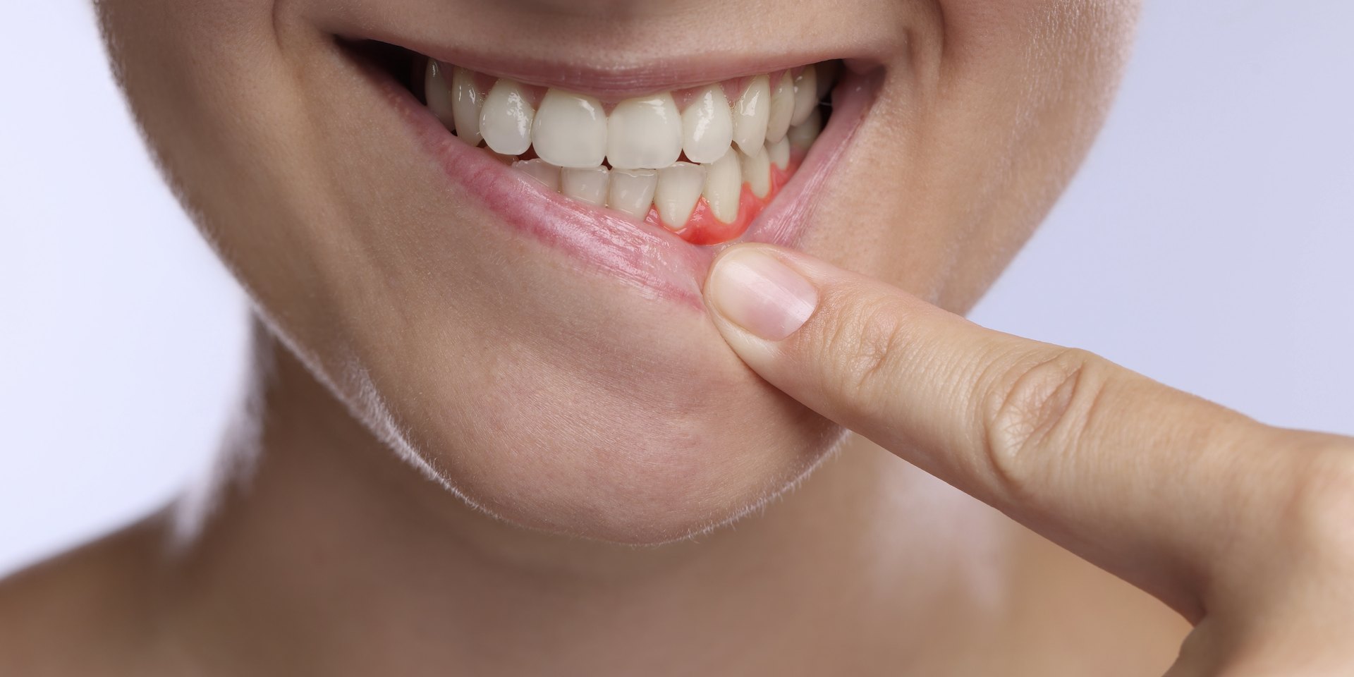 Mujer que se baja el labio inferior y enseña la encía inflamada y enrojecida