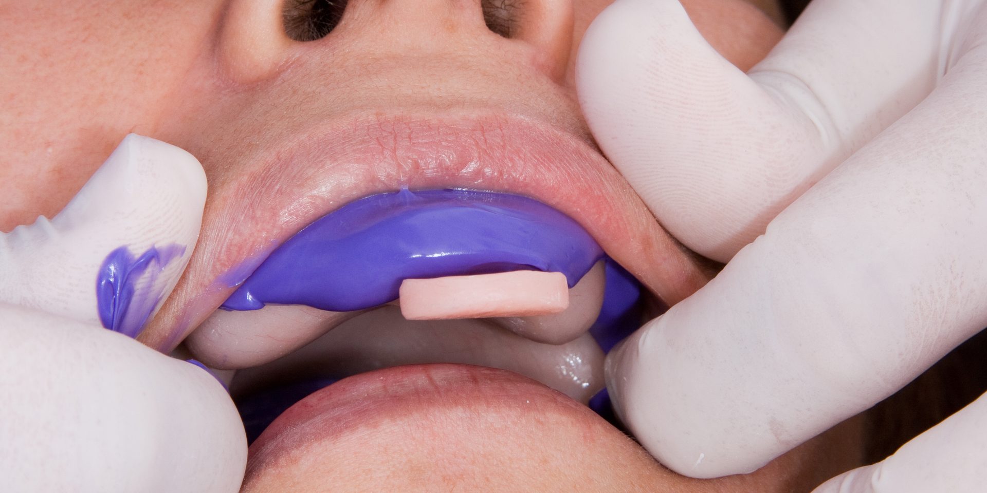 Dentista tomando el molde de la boca de una paciente con una cubeta de impresión