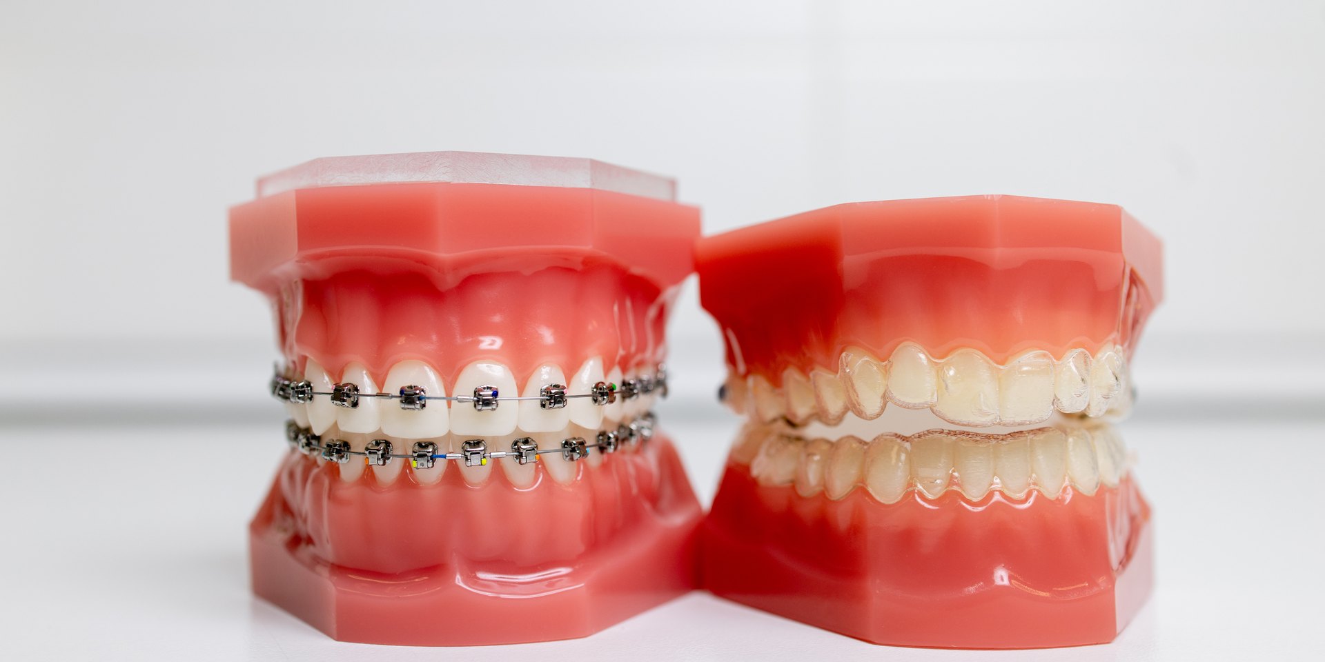 Dos modelos dentales: uno con brackets metálicos y otro con alineadores transparentes
