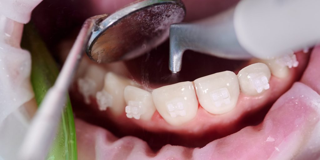 Primer plano de una limpieza dental con el aparato de ultrasonidos y el espejo sobre los dientes inferiores