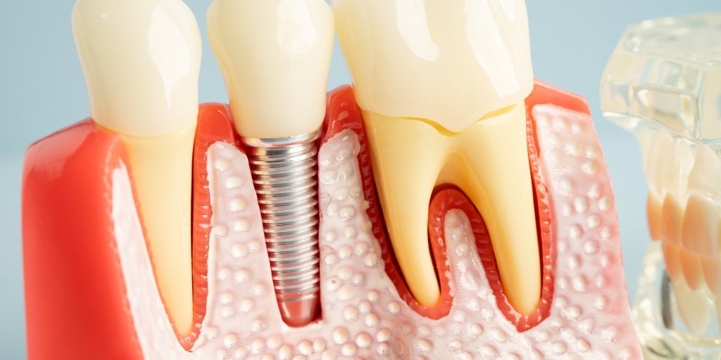 Modelo de la mandíbula en corte con un implante dental entre dos dientes naturales, que deja ver el hueso y la encía