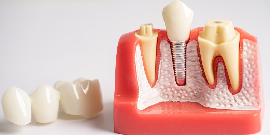Modelo de encía en sección con un implante dental y su corona entre dos dientes naturales, junto a varias coronas sueltas