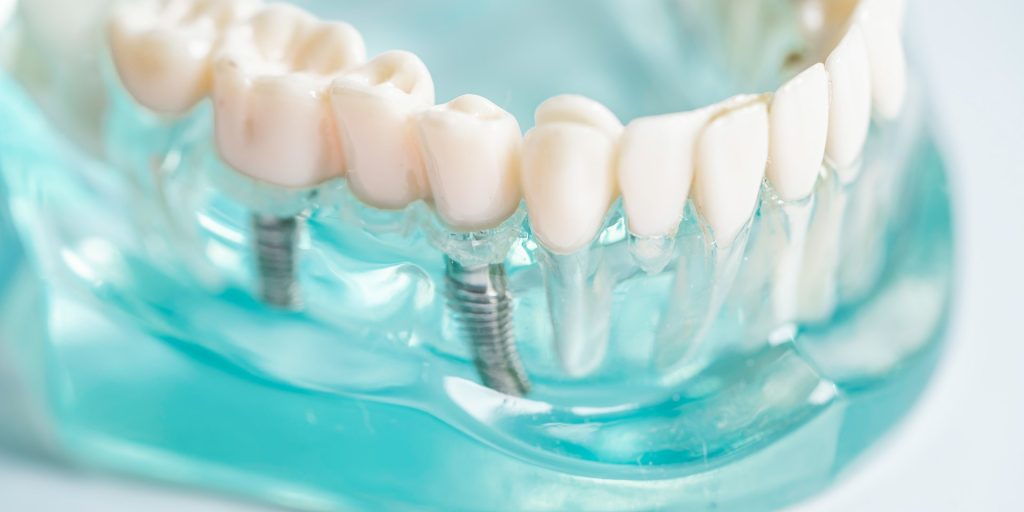 Modelo transparente de mandíbula con dos implantes dentales de titanio que sujetan una prótesis fija