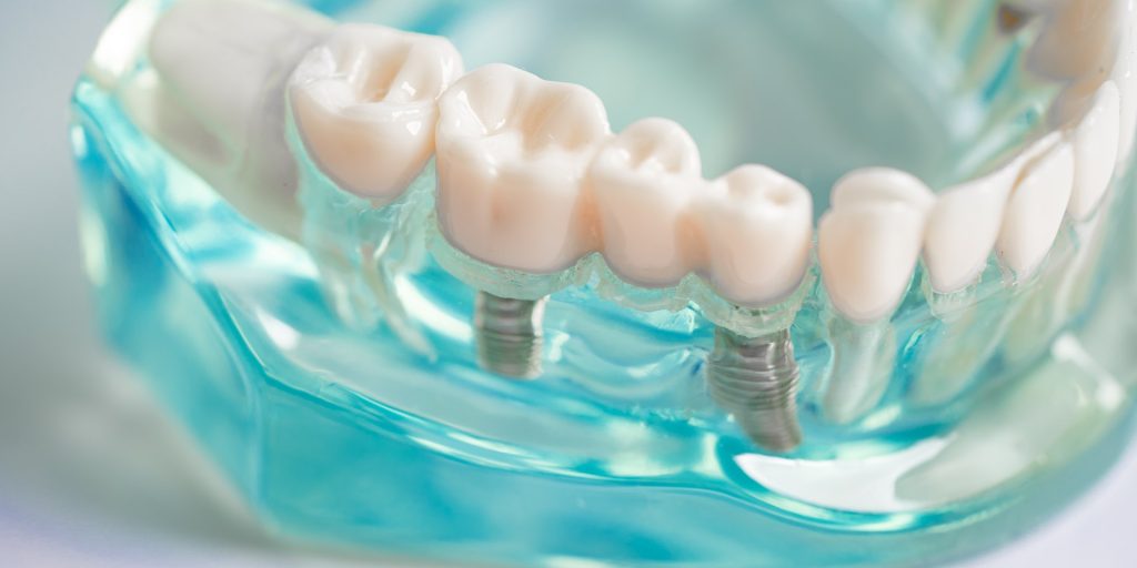 Modelo transparente de mandíbula con un puente de varias coronas sujeto por implantes dentales