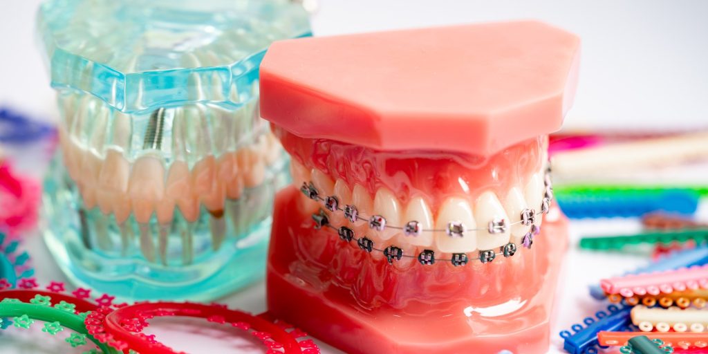Dos modelos de dentadura, uno de ellos con brackets metálicos, rodeados de ligaduras elásticas de colores