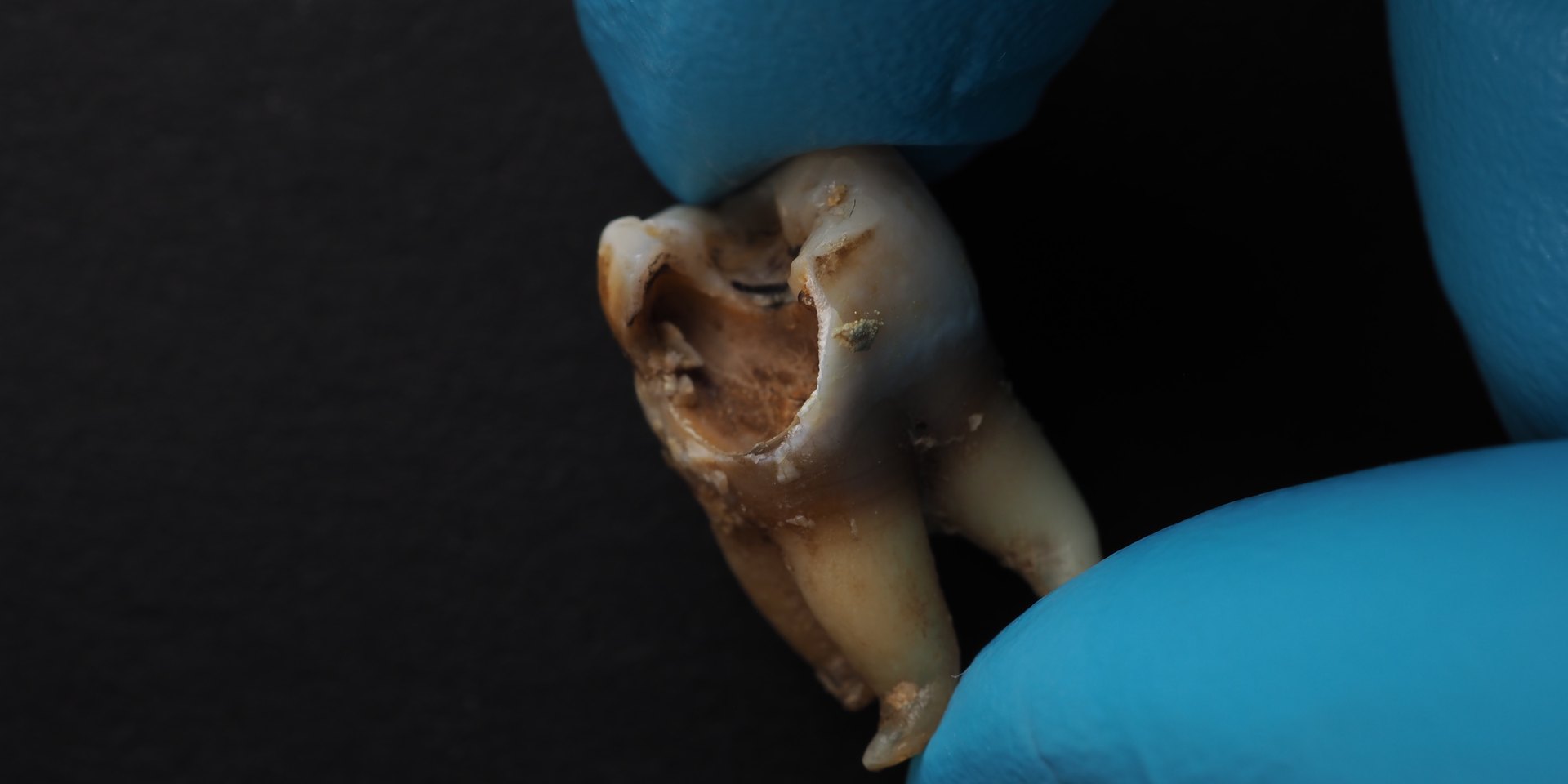Muela con la corona rota por una caries grande, sujeta entre los dedos con guantes de dentista