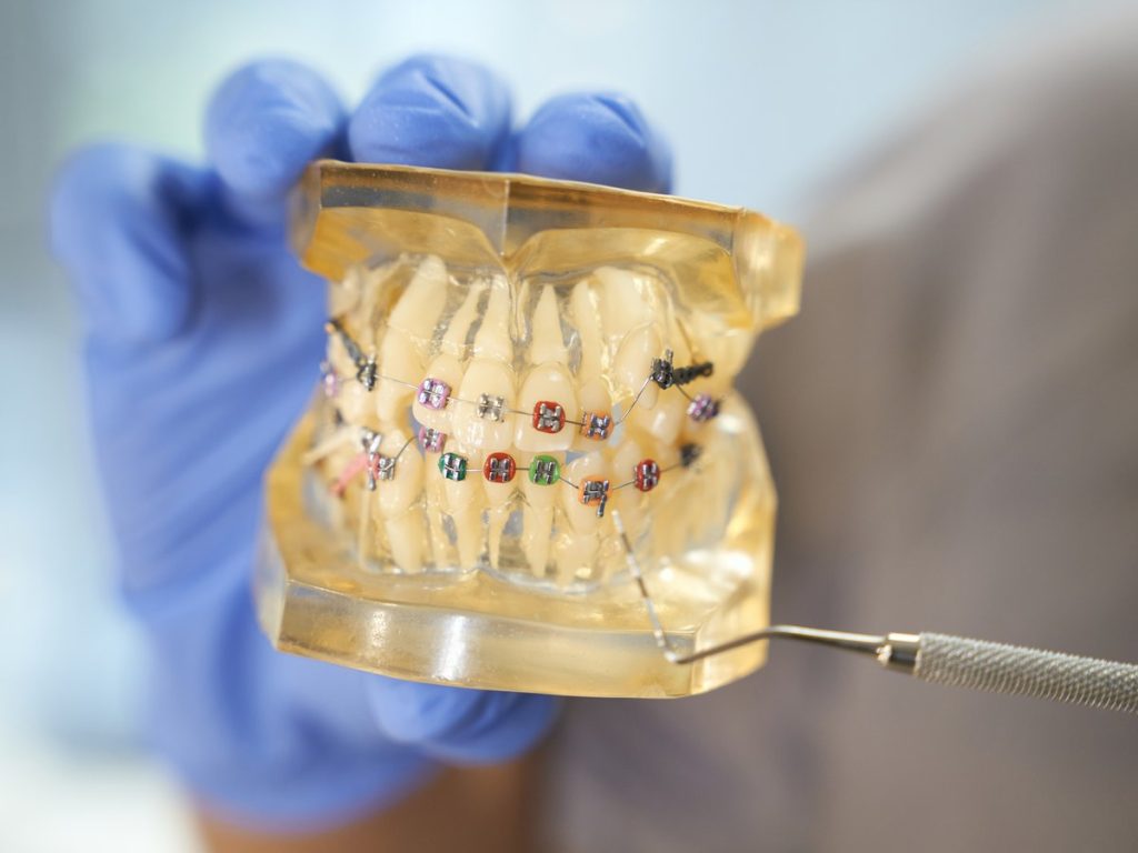 Mano con guante sosteniendo una maqueta dental transparente con brackets de colores