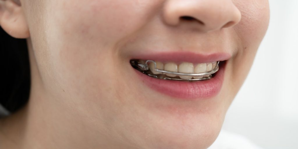 Sonrisa de una mujer que lleva un retenedor removible con el alambre sobre los dientes delanteros