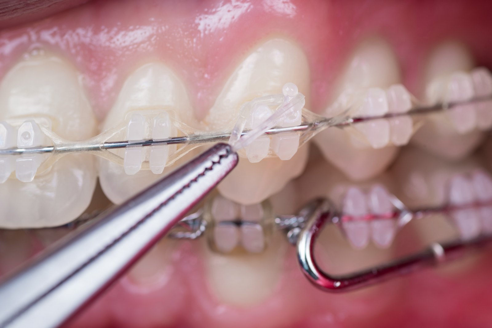 Pinza de ortodoncia colocando una ligadura en unos brackets de cerámica