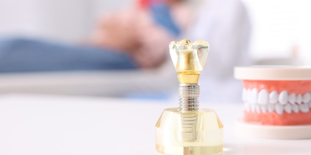 Modelo de implante dental con su corona junto a una maqueta de dentadura