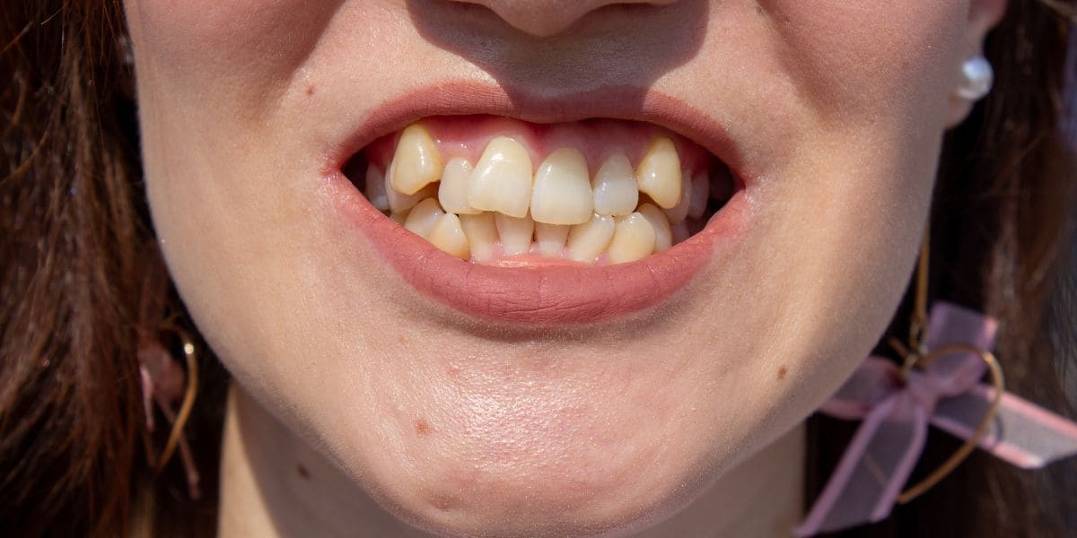 dientes torcidos