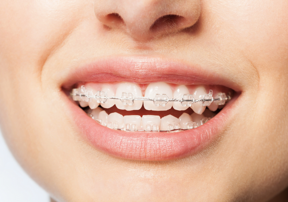 Brackets De Cerámica ZARAGOZA CLINICA CARDONA