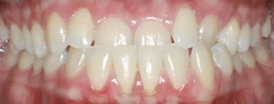 ortodoncia invisible antes 1