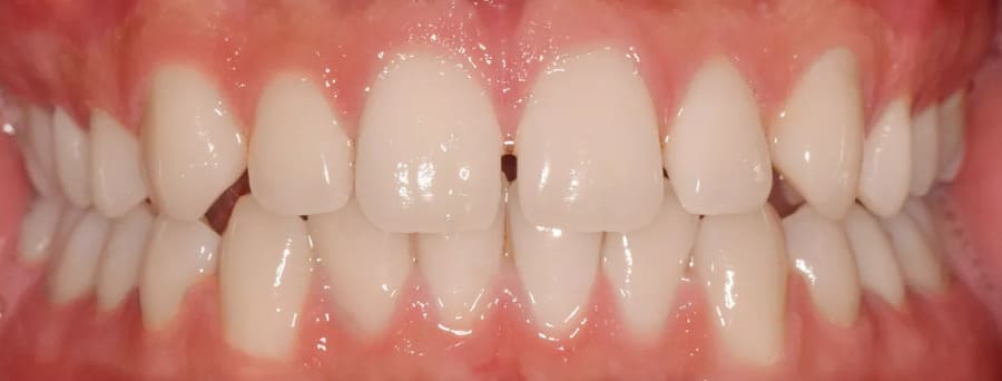 ortodoncia invisible antes 2