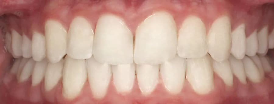 ortodoncia invisible después 3