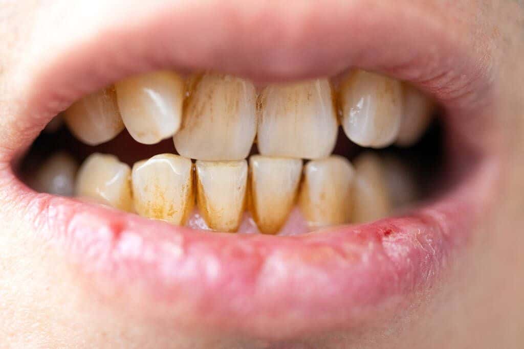 manchas amarillas y marrones en los dientes