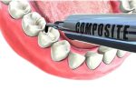 WHAT IS DENTAL COMPOSITE AND WHAT IS IT FOR?