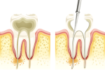 MULTIRADICULAR ROOT CANALS: WHAT IS IT?