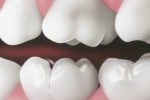DENTAL FISSURES: WHAT THEY ARE
