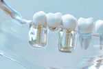 CELEBRITIES WITH DENTAL IMPLANTS, GET TO KNOW THEM!