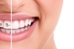 INVISALIGN OR BRACES: WHICH IS BETTER